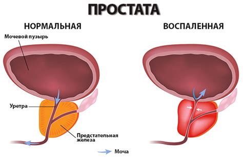 размер на простатата при хроничен простатит